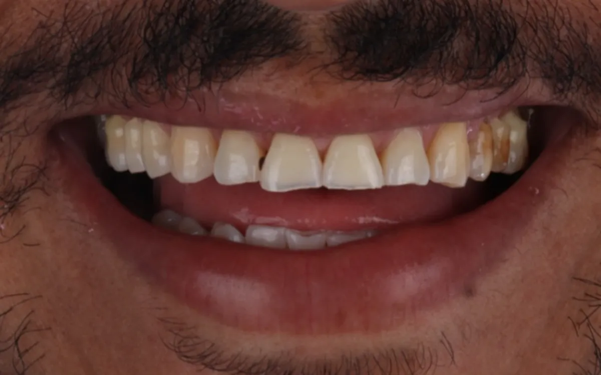 Antes: dentes amarelados, desgastados e com espaços