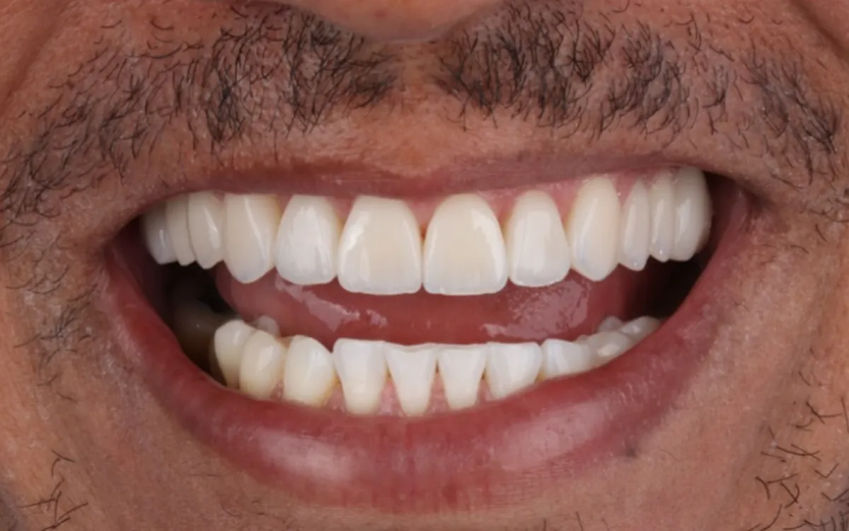 Depois: lentes em porcelana, dentes claros e alinhados