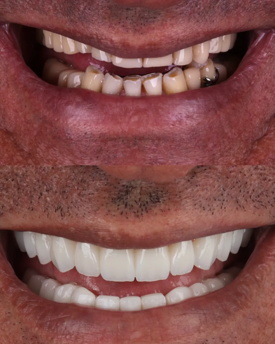 Antes e depois do sorriso do paciente de 65 anos: de dentes desgastados para dentes fixos e claros