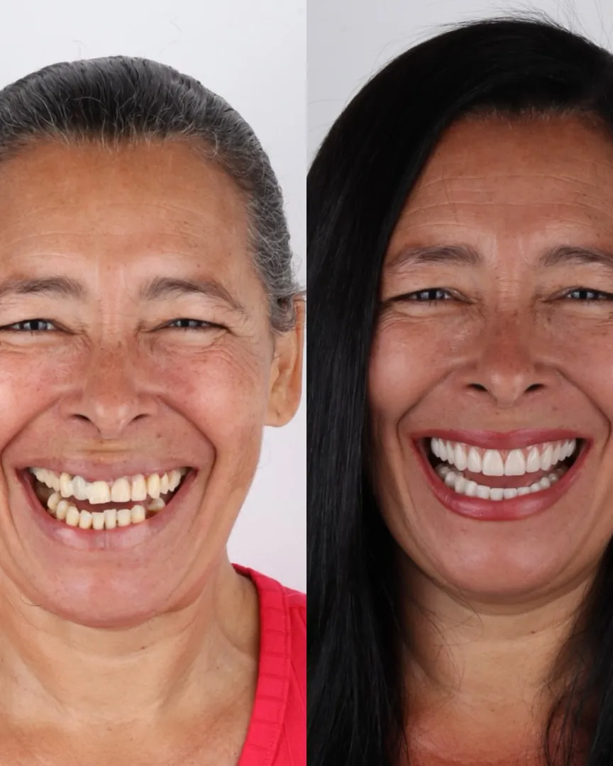 Dona Eliana antes e depois da prótese protocolo, sorrindo de cabelo solto e batom