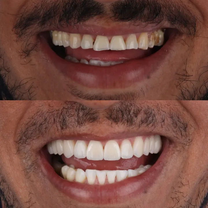 Antes e depois: dentes amarelados e irregulares transformados com lentes em porcelana