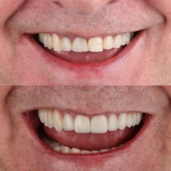 Antes e depois de um retrabalho com lentes em porcelana