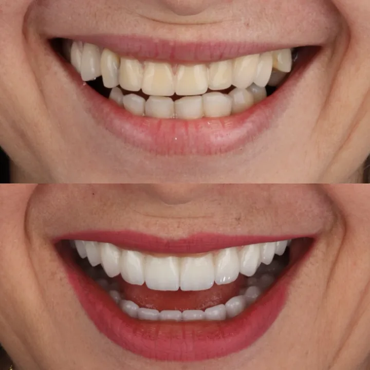 Antes e depois de sorriso com dentes desalinhados e escurecidos