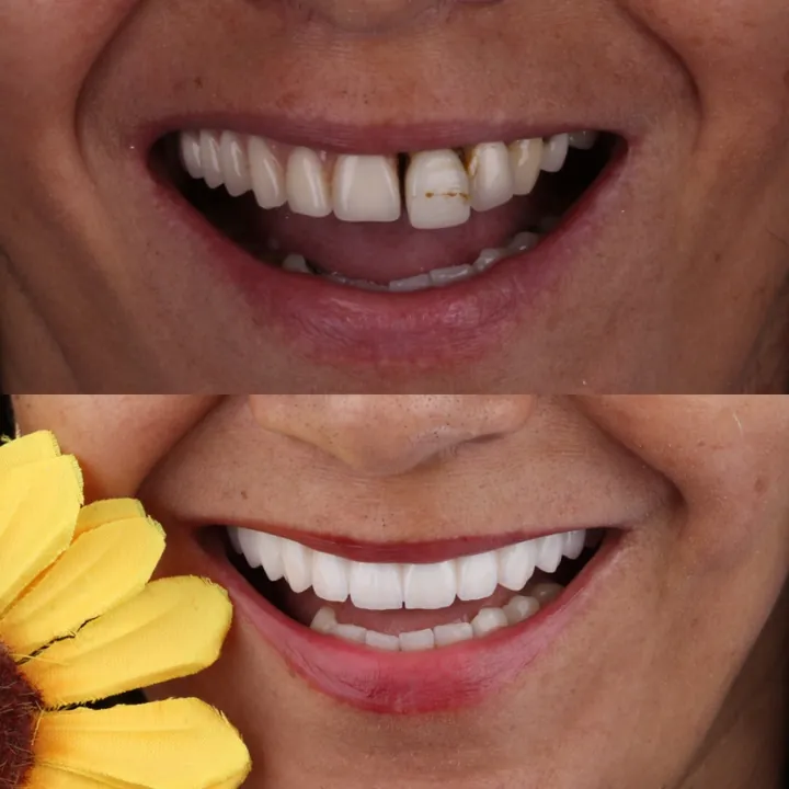 Antes e depois de sorriso com dente escurecido e espaço entre os dentes