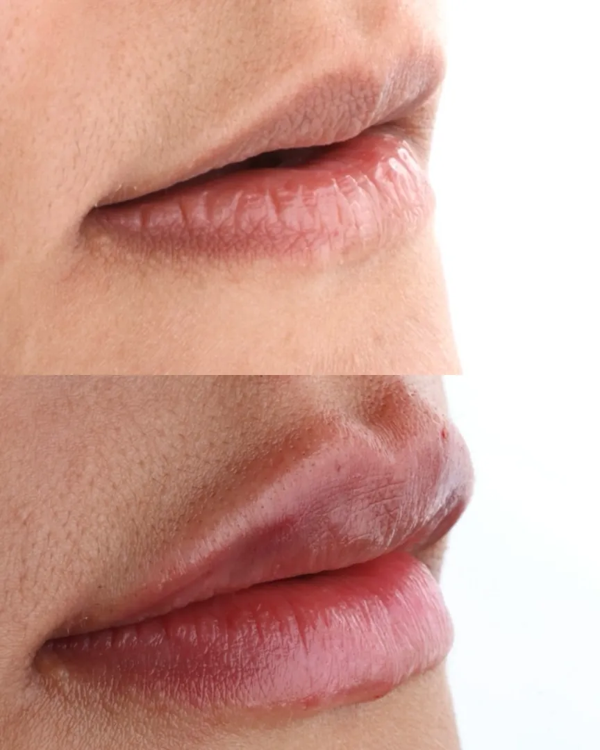 Antes e depois de preenchimento labial, de lábios finos para lábios mais definidos