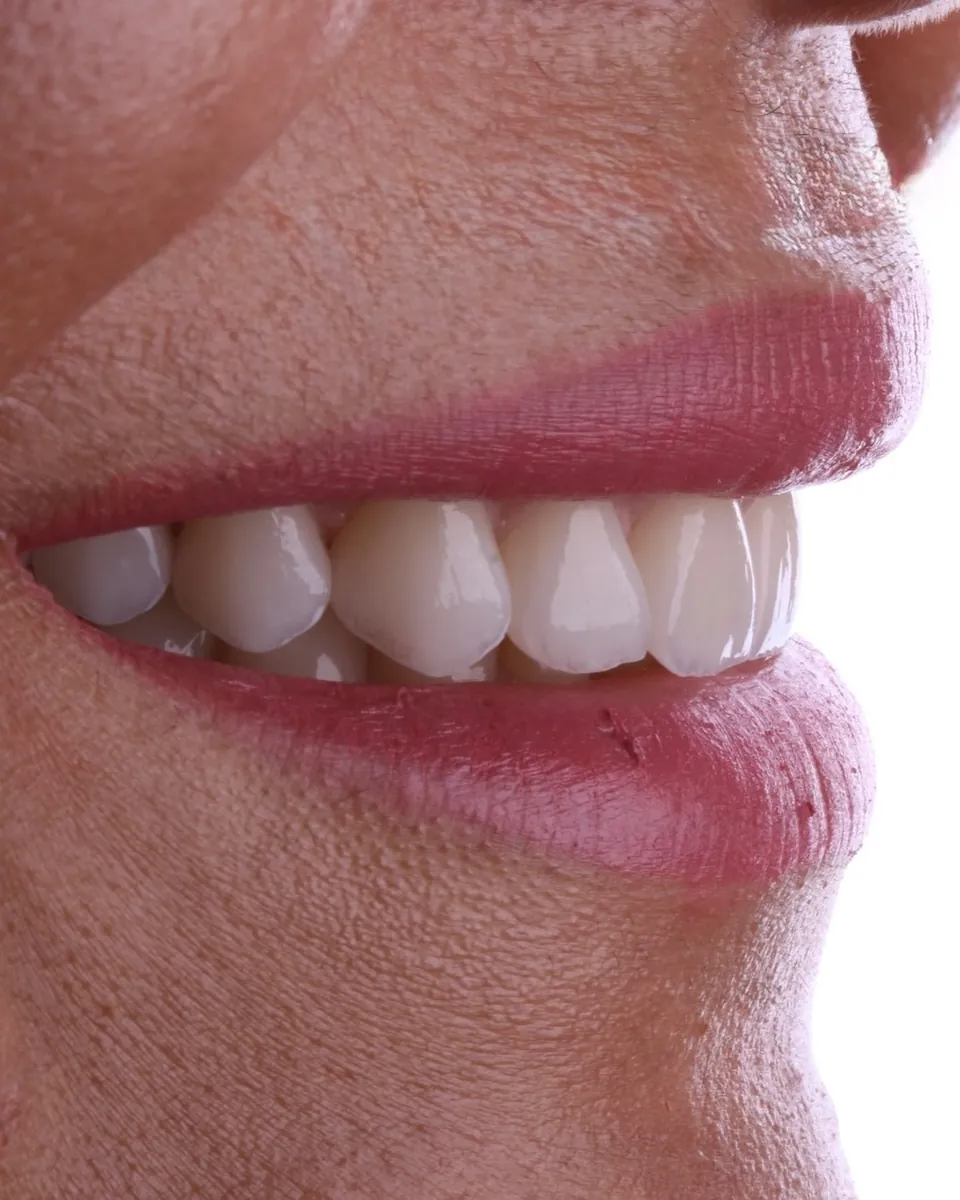 Sorriso de perfil com lentes em porcelana de aparência natural