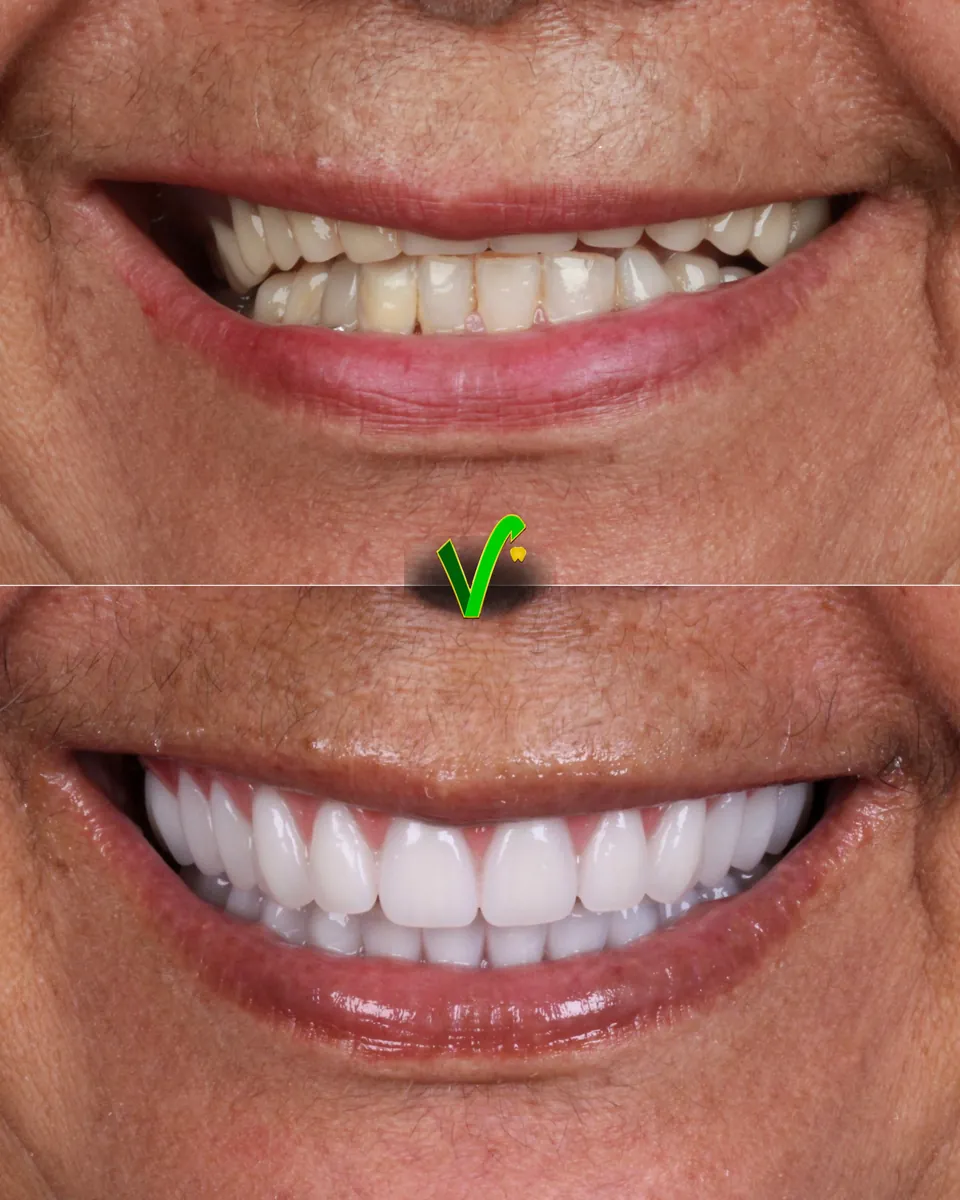 Antes e depois de reabilitação com implantes: dentes desgastados substituídos por dentes claros e alinhados